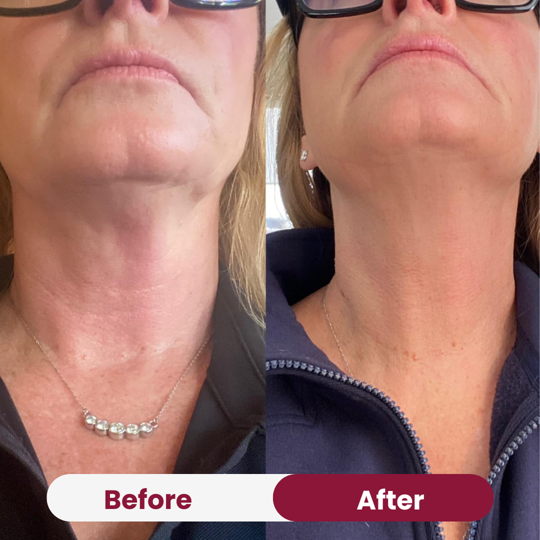 Neck Tightening Cream