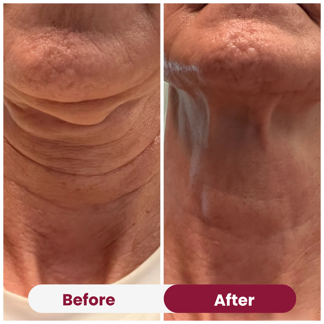 Neck Anti-Wrinkle Patch