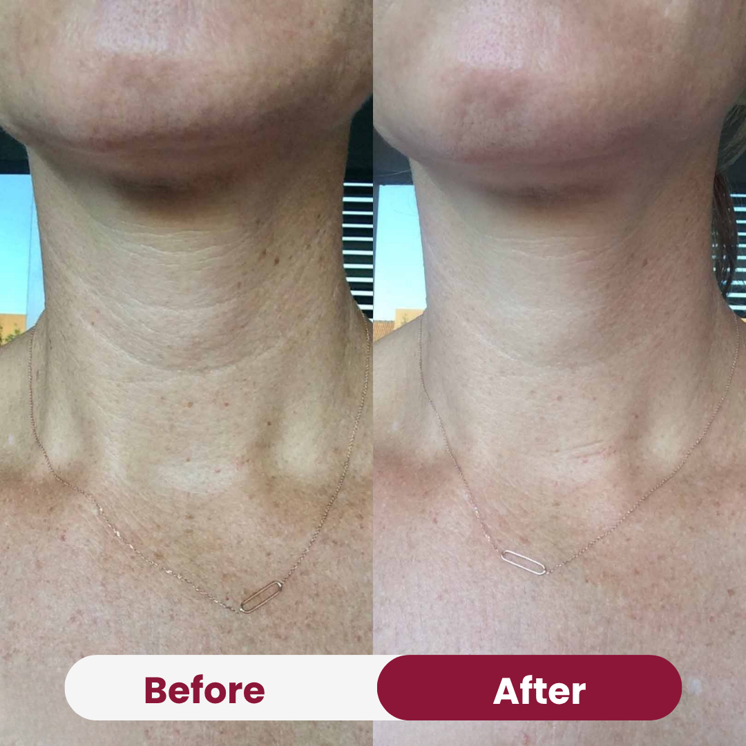 Neck Anti-Wrinkle Patch
